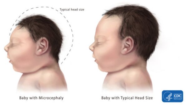 A comparison of a typical head size for a baby and a baby with microcephaly.