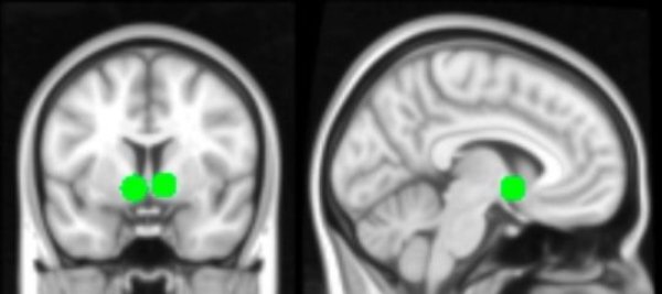 Two views of the brain with the nucleus accumbens, a hub of the brain's reward circuitry, highlighted in green. This region was more active when teenagers saw that their own photographs, and those of others, had been "liked" by more peers. Past research suggests that this region is particularly sensitive in adolescence.