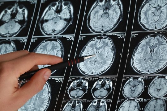 Teens with type 2 diabetes have six regions with significantly less gray matter, and three with significantly more. They found a relationship between less gray matter volume in the brain and the ability to pronounce and sound out unfamiliar words.