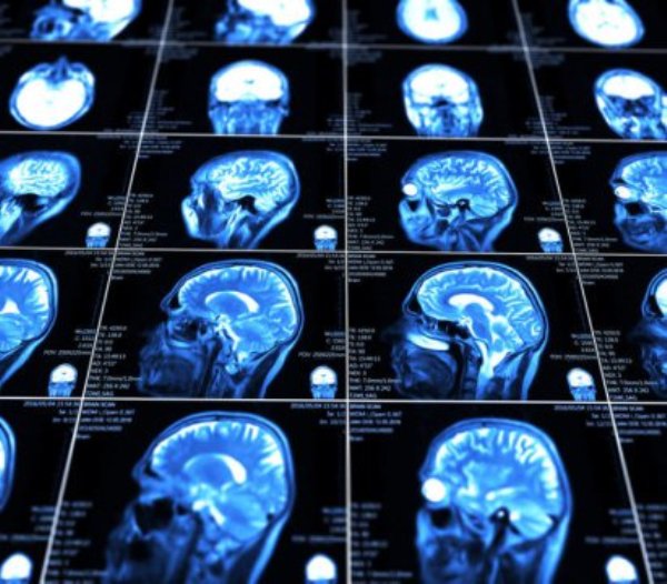 Brain scans