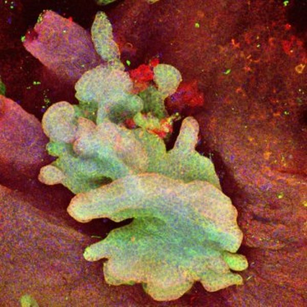 The green-labelled cells show a basal cell carcinoma in mouse tail epidermis derived from a single mutant stem cell and expanding out of the normal epidermis stained in red.