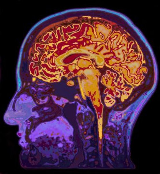 Brain scan