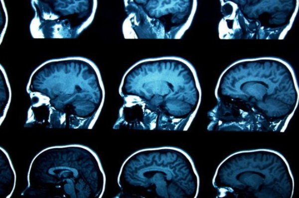 Brain scans (stock image). Autism, ADHD and OCD have common symptoms and are linked by some of the same genes. Yet historically they have been studied as separate disorders.