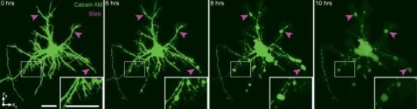 Using a technique that can image neurons in real time following the application of compressive strain, researchers from Brown University have shown that irreversible damage occurs in cells about six hours after a trauma in lab samples. The finding suggests that there might be a window of therapeutic intervention aimed at limiting the damage in people who have suffered a blow to the head. The image shows the formation of "blebs" in neural axons, a tell-tale marker of traumatic brain injury.