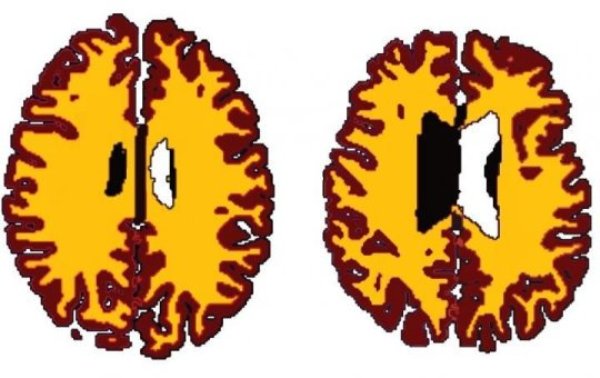 Comparison of grey matter (brown) and white matter (yellow) in sex-matched subjects A (56 years, BMI 19.5) and B (50 years, BMI 43.4)