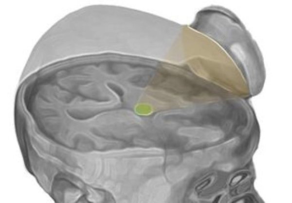 The researchers targeted the thalamus with low-intensity focused ultrasound pulsation.