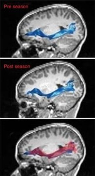 MR images of left inferior fronto-occipital fasciculus (top) before and (middle) after the playing season, and (bottom) the overlay. In the overlay (bottom), the red region is after the season and the blue region is before the season.