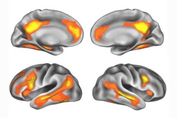Brain regions with volume changes after pregnancy.