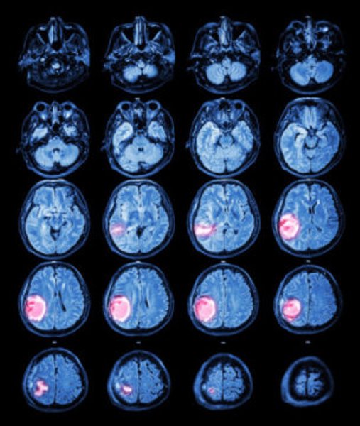 MRI images of a brain tumor.
