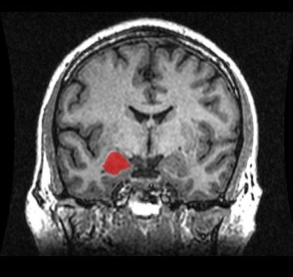 MRI coronal view of the amygdala.