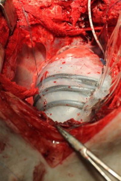 In vivo demonstration of cardiac assist in a porcine model of acute heart failure (Video courtesy of Ellen Roche/Harvard SEAS)