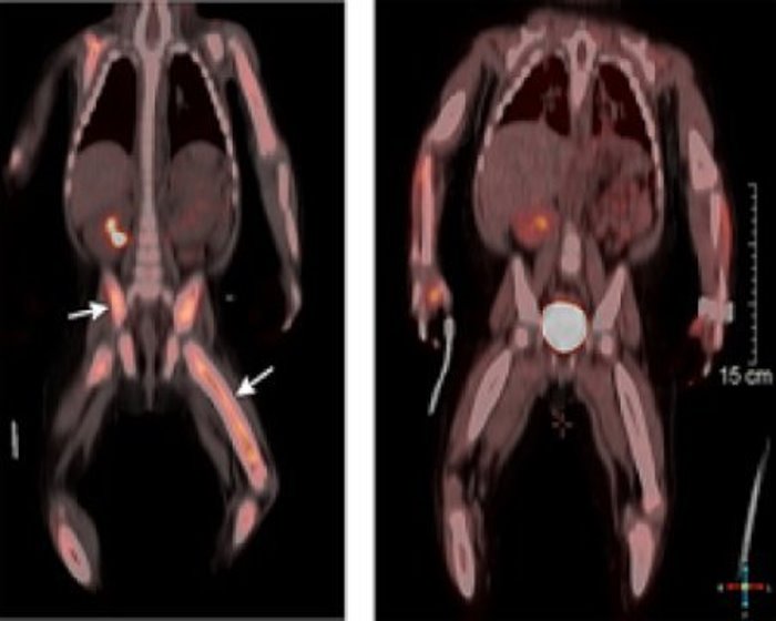 PET-CT images of a 10-month-old child with Langerhans cell histiocytosis (LCH) show increased disease activity in the bones (left image). Three months after the start of oral therapy with the drug dabrafenib, the image on the right shows near complete resolution of disease activity. The child was part of a study in JCI Insight from Cincinnati Children’s summarizing outcomes of off-label oral therapy in patients with histiocytoses that were resistant to chemotherapy. Study authors recommend additional study, including clinical trials to further test the therapeutic approach.