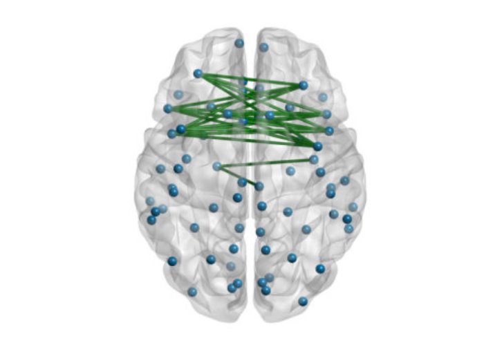 Highly creative people have significantly more white matter connections (shown in green) between the right and left hemispheres of the brain, according to a new analysis.