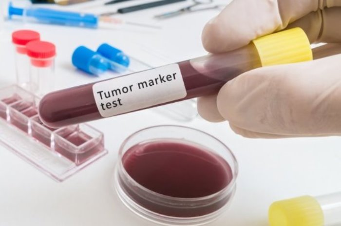 DNA from tumour cells is known to end up in the bloodstream in the earliest stages of cancer so offers a unique target for early detection of the disease.