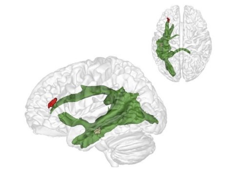 The maturation of fibres of a brain structure called the arcuate fascicle (green) between the ages of three and four years establishes a connection between two critical brain regions: A region at the back of the temporal lobe (brown) that supports adults thinking about others and their thoughts and a region in the frontal lobe (red) that is involved in keeping things at different levels of abstraction and, therefore, helps us to understand what the real world is and what the thoughts of others are.
