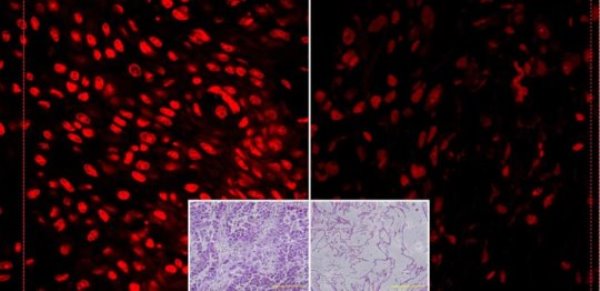 This image shows differential susceptibility of normal cells (left) and cancer cells (right) to vtamin C.