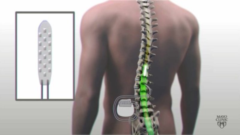 A combination of this technology and rehabilitation may help patients with spinal cord injuries regain control over previously paralyzed movements, such as steplike actions, balance control and standing, say researchers.