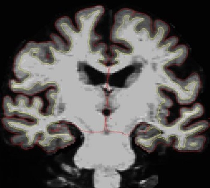 This is a MRI scan of a SuperAger's brain. The portion between the yellow and red lines is the cortex, which contains neurons. SuperAgers' cortices shrunk over two times slower than average-age peers' in a recent Northwestern Medicine study, which may contribute to their superior memory performance.
