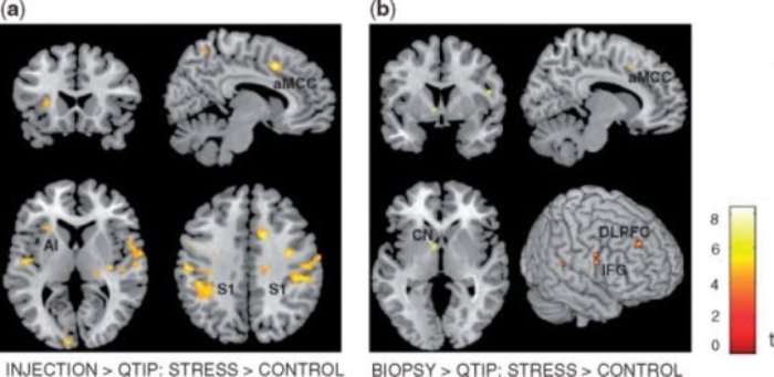 MRI scans of the brain: stress-induced brain activation during viewing pictures of other people in painful situations. The results show that the neural empathy network in people under stress was more sensitive to the pain of others.