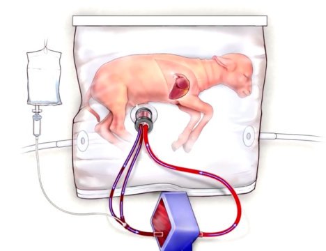 Medical researchers have developed an extra-uterine support device. They tested and monitored effects on fetal lambs, in which prenatal lung development is very similar to that occurring in humans.