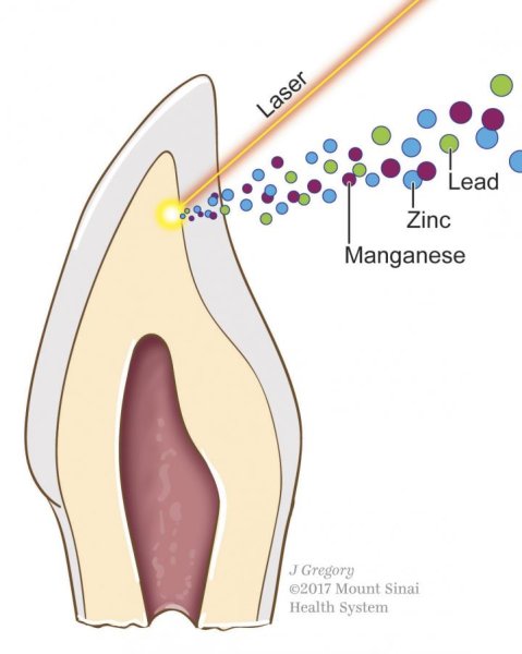 This is a cross-section of tooth showing laser removal of the dentine layer, in tan, for analysis of metal content.