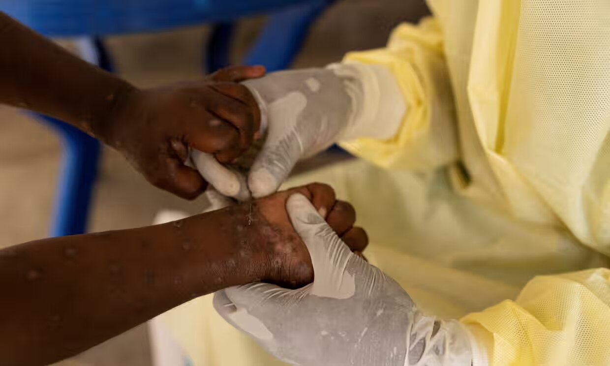 Mpox is a viral disease that spreads from animals to humans but can also be transmitted through close physical contact. 