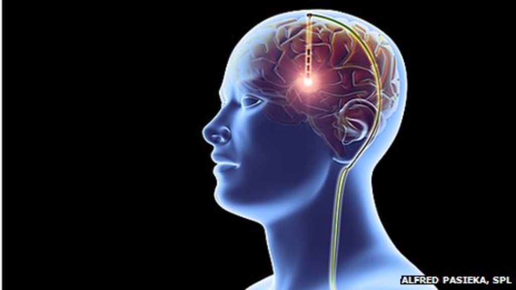 N. Scott Litofsky performs a surgery at University of Missouri Health Care. Researchers compared two common postsurgical therapies for metastatic brain tumors and found that stereotactic radiosurgery can provide better outcomes for patients compared to whole-brain radiation.
