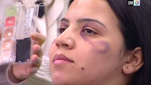 The segment on Channel 2M demonstrated how it was possible to hide bruising with make-up