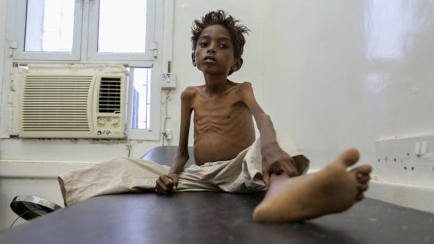 Five-year-old Mohannad Ali sits in hospital in Yemen in December. His younger cousin - aged just two - died of hunger