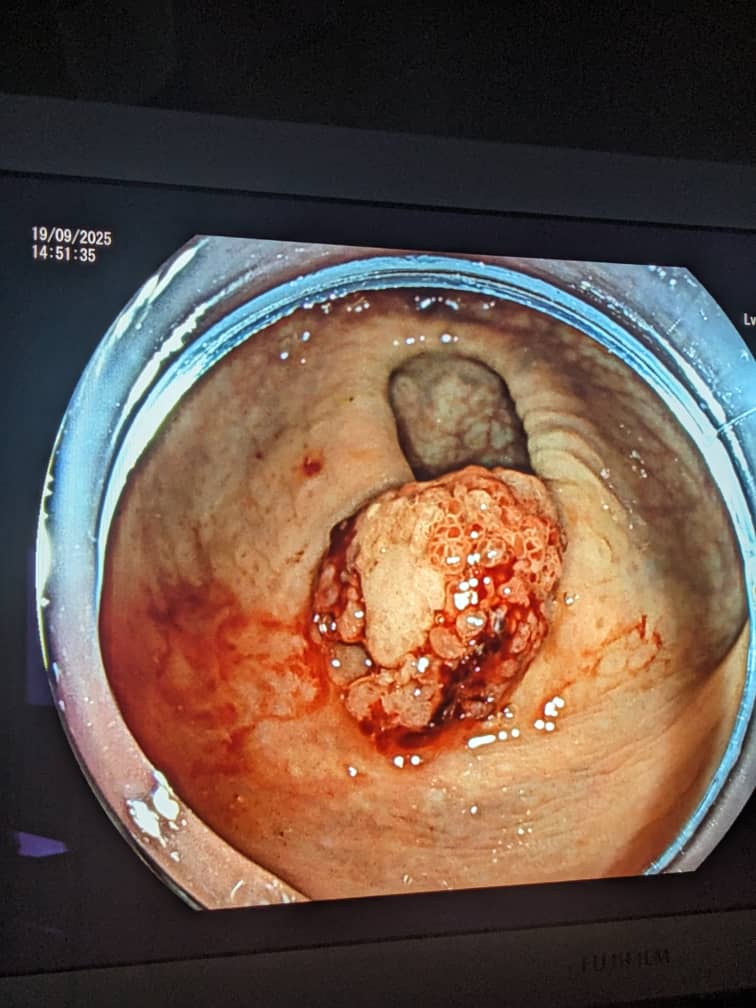 Endoscopic Submucosal Dissection (ESD) is a modern, less-invasive technique used to remove tumors from the digestive system.