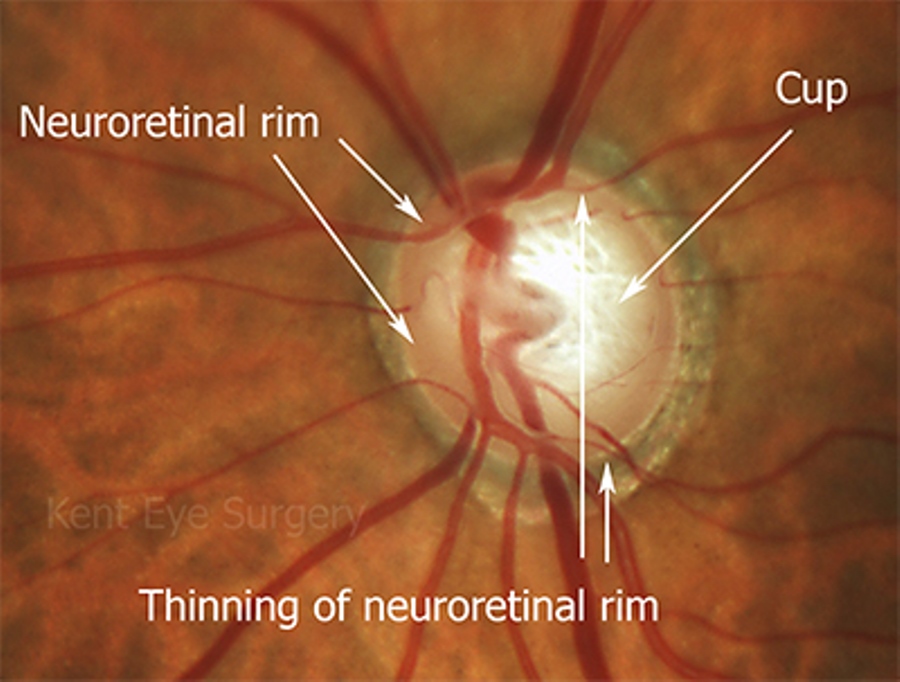 Glaucomatous optic disc