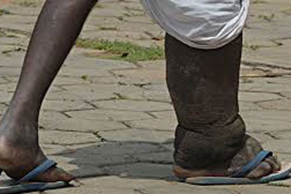 Researchers found that people carrying the parasite that can cause elephantiasis were twice as likely to also have the AIDS virus. The impact was highest among adolescents and young adults.