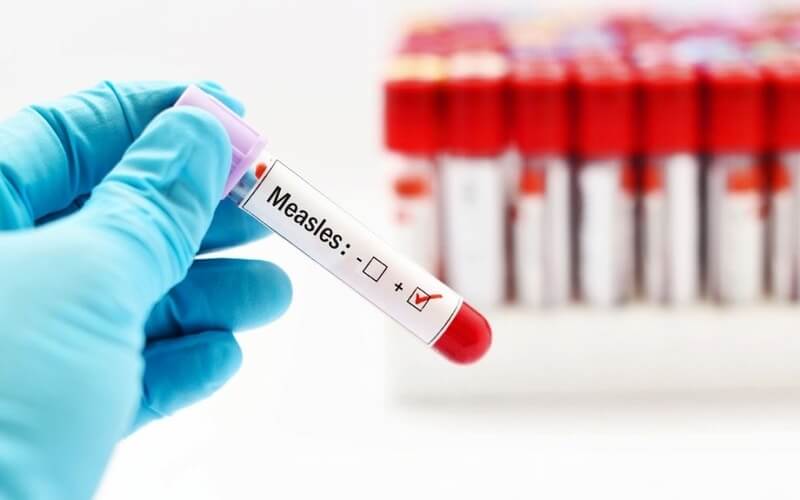 In a situation update on Monday, April 21, Uganda's Ministry of Health said nine cases of the viral disease had been confirmed in the previous week—five at Nakivale and Oruchinga refugee settlements in Isingiro district and four at Matanda transit centre in Kanungu district.