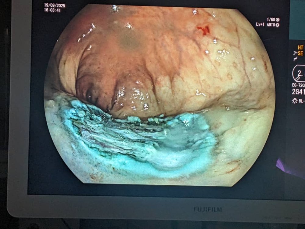 King Faisal Hospital in Rwanda has achieved a major medical breakthrough by performing the first-ever endoscopic surgery to treat early-stage lower rectal cancer.
