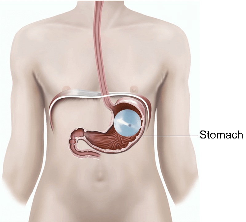 The procedure, known as gastric balloon placement, is an outpatient treatment widely used globally to assist with weight management.