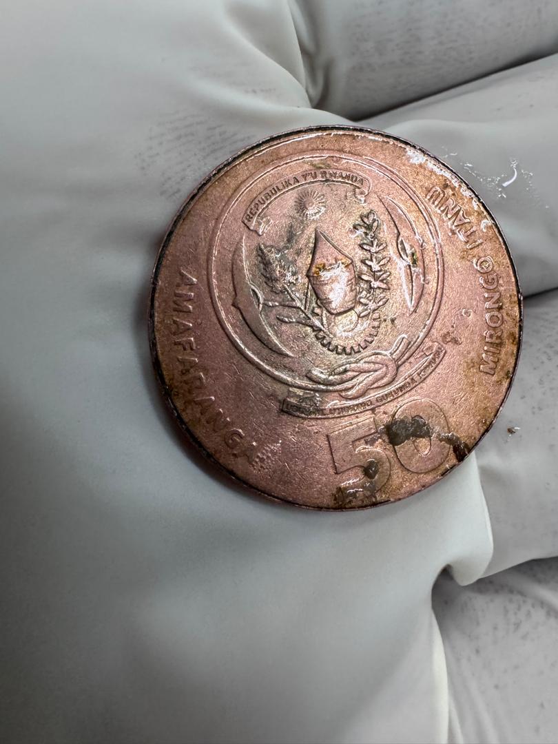 The coin had been lodged in the baby’s stomach for a month.