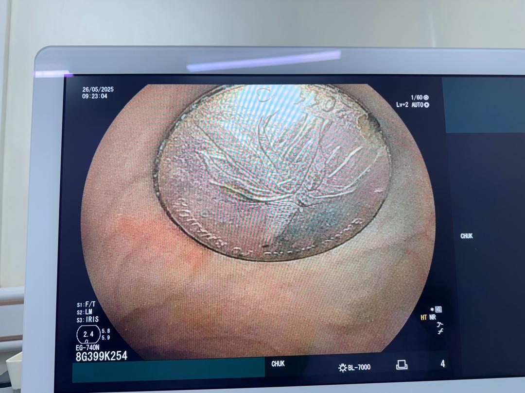 The child’s mother said she had initially been told that surgery would be necessary to remove the coin. 