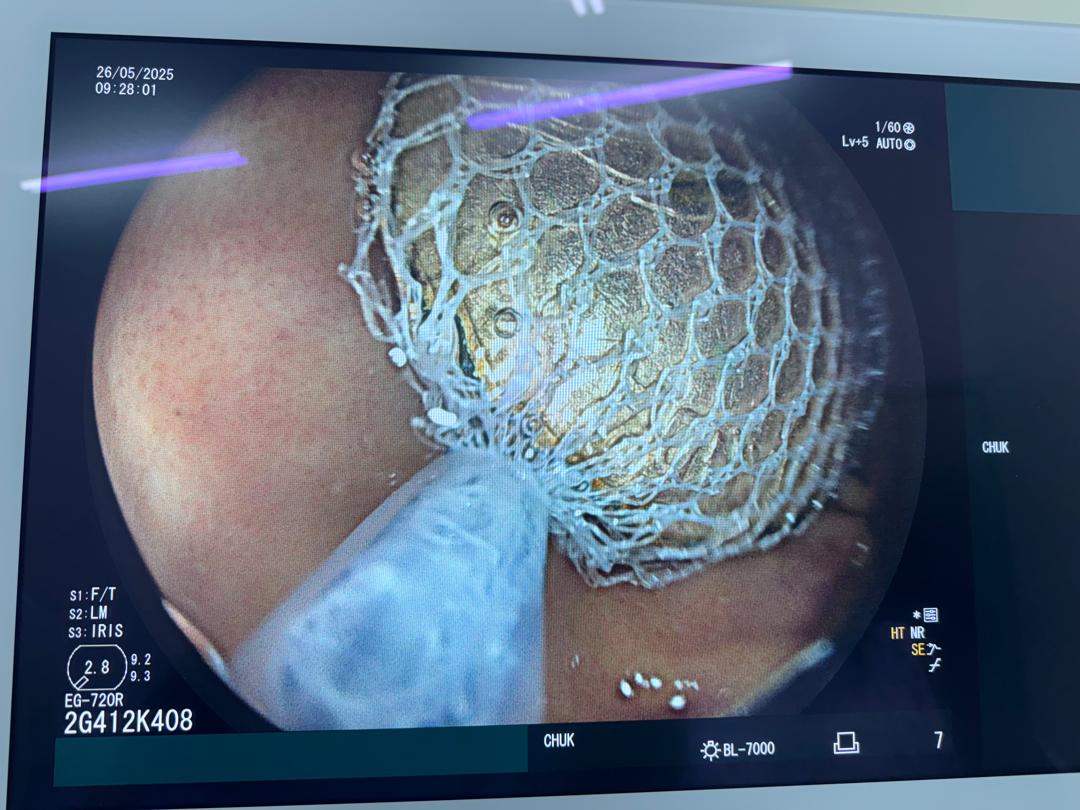 Doctors extracted the coin using endoscopy, a minimally invasive procedure that avoided the need for surgery.