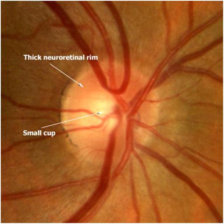 Normal Optic disc
