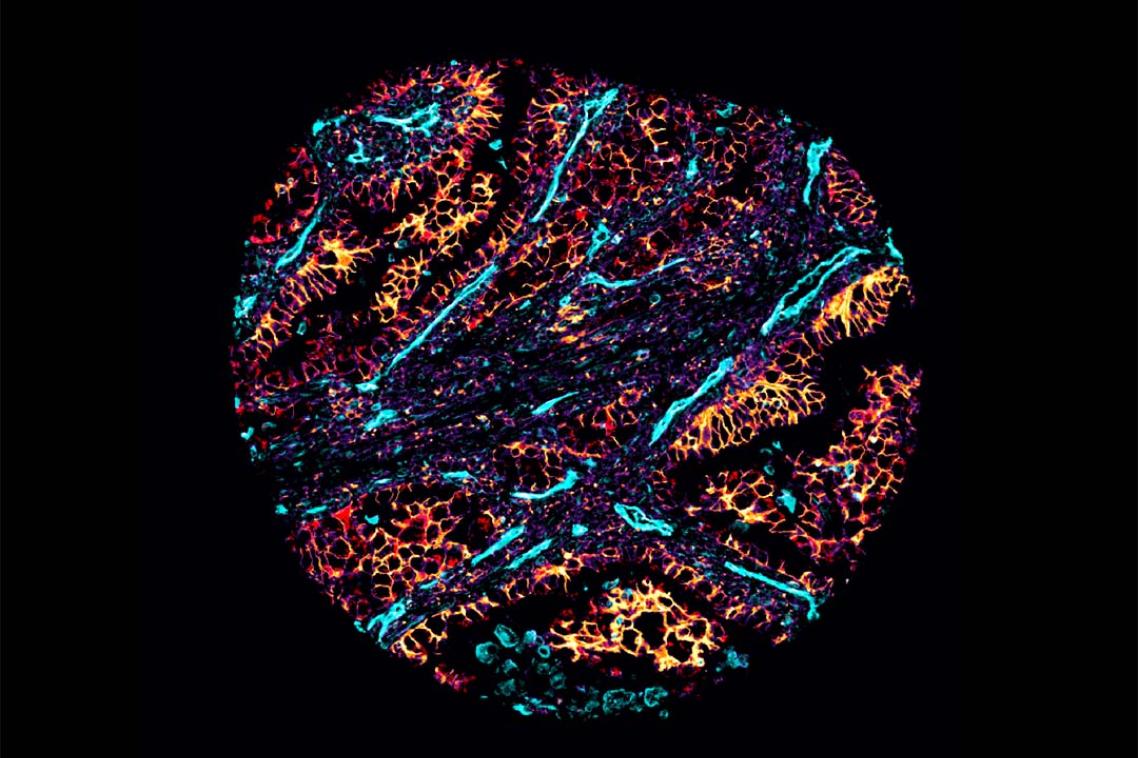 A cancer cell featuring metabolic uptake (in yellow) and vessels (in blue). Photo credit: The University of Queensland