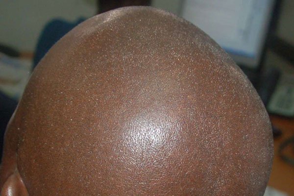 Warning comes after two bald men were killed in brutal attacks, with body parts thought to have been used in witchcraft rituals.