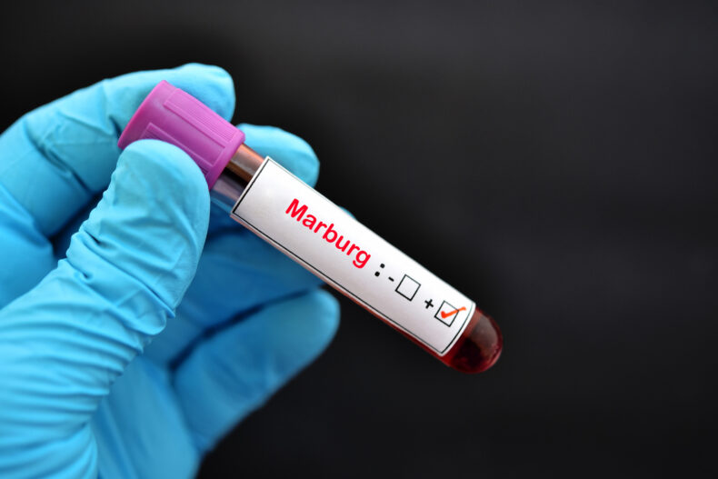 The Marburg virus outbreak, which has been reported in two districts, Biharamulo and Muleba, has raised alarm due to its high case fatality ratio (CFR) of 89% and its potential regional implications.