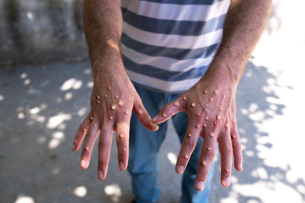 Mpox has been reported in the USA