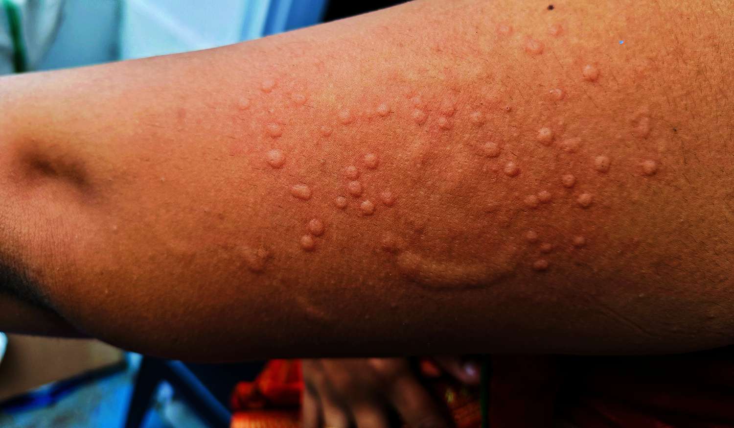 The World Health Organization (WHO) on August 14, 2024, announced that the mpox outbreaks in the Democratic Republic of the Congo and other countries in Africa are a public health emergency of international concern.