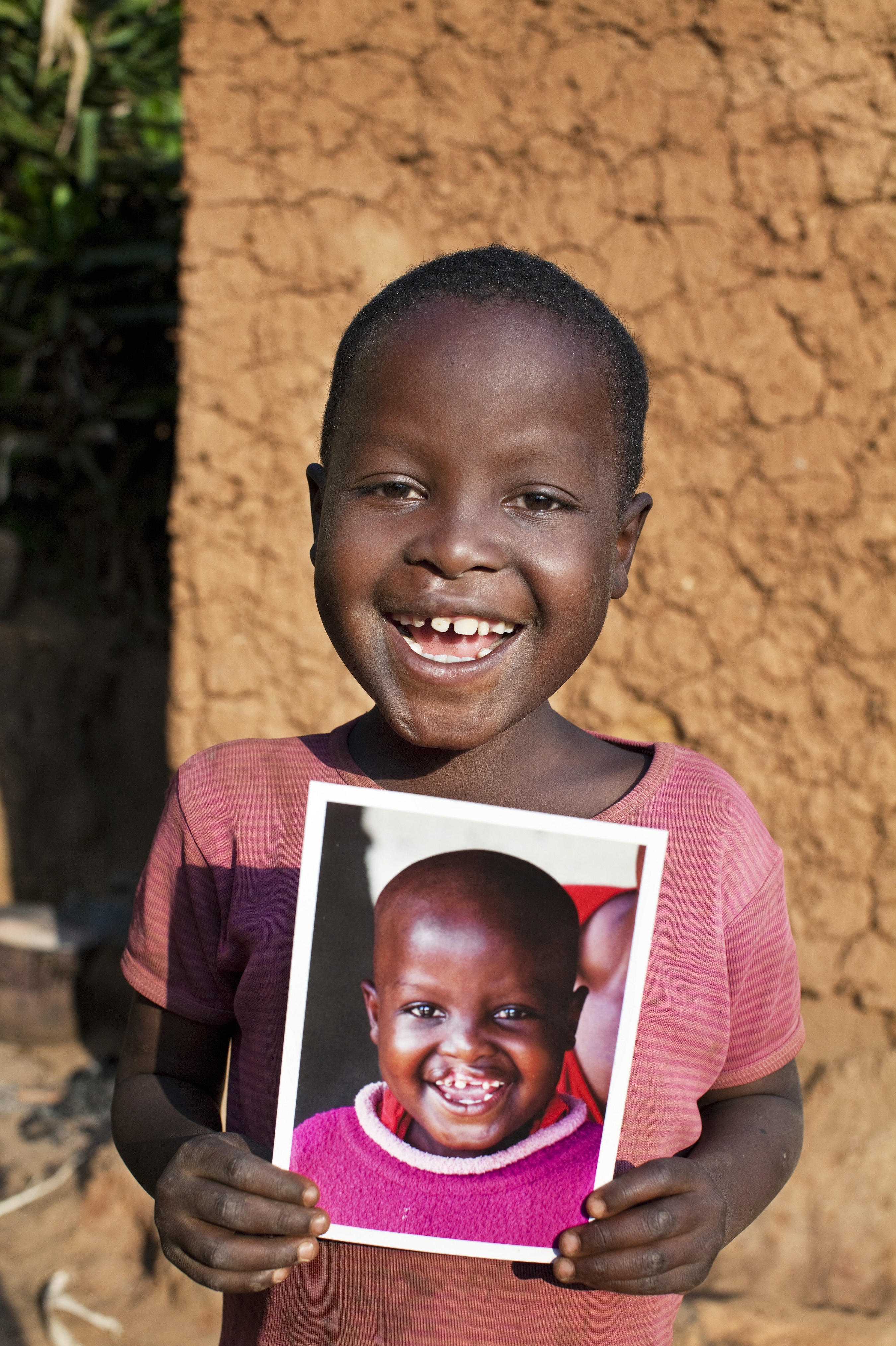 Habimana after free cleft lip surgery