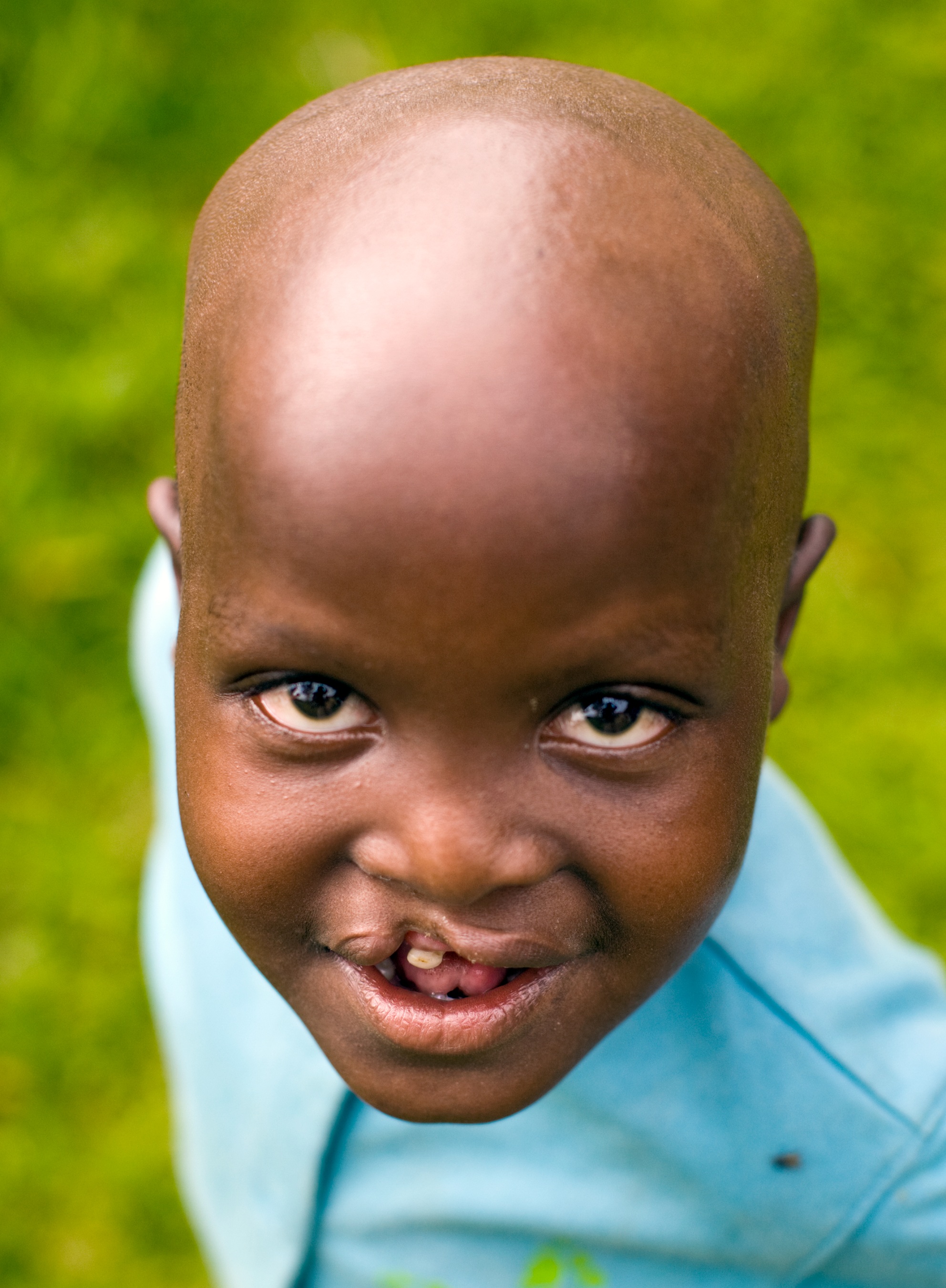 Habimana before free cleft lip surgery
