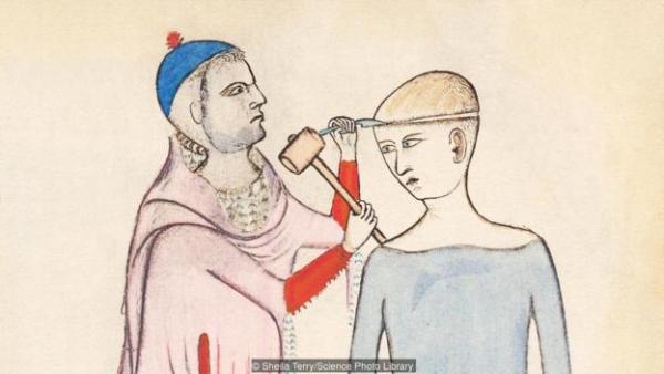 A 14th-Century painting of trepanation by Guido da Vigevano