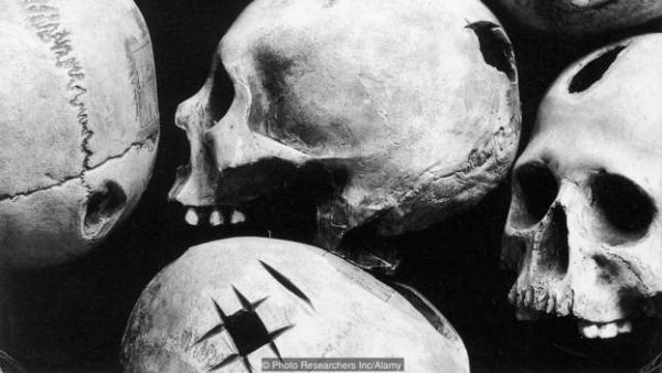 Casts of trepanned Peruvian skulls