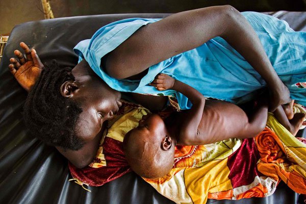 A mother breastfeeding her child who suffers acute malnutrition at the clinic run by Doctors Without Borders (MSF) in Aweil, northern Bahr al-Ghazal, South Sudan on October 11, 2016.