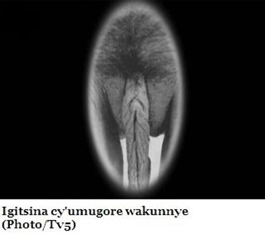 This Pic shows Elongated labia